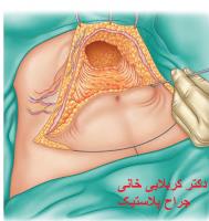 جراحی شکم عروق شکم
