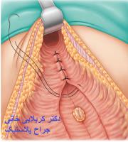 جراحی پلاستیک شکم دوختن عضلات راست شکمی