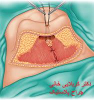 جراحی شکم مرحله ای جابجایی ناف