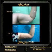 جراحی و لیفت بازو