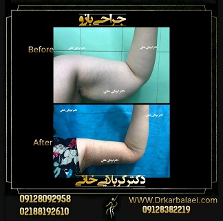 جراحی و لیفت بازو