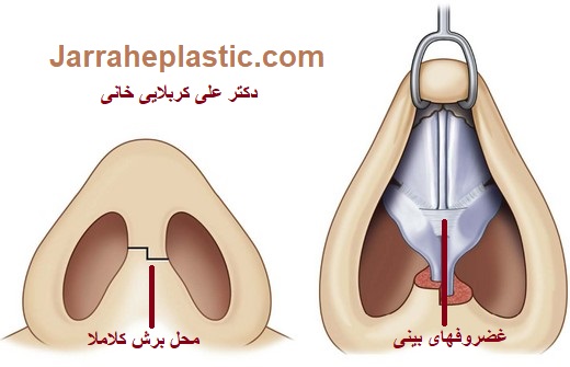 جراحی بینی 2