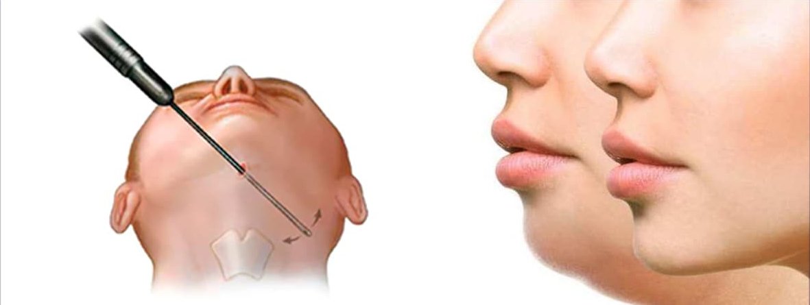 لیپوساکشن غبغب 