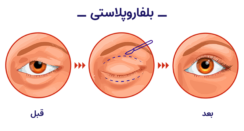 جراحی پلک(بلفاروپلاستی)