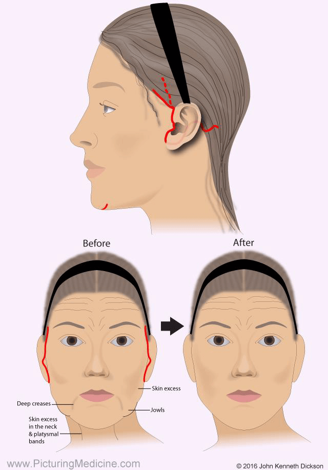 لیفت صورت و گردن