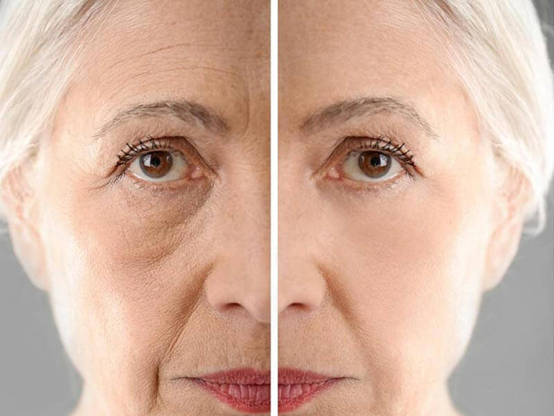 جراحی لیفت صورت 2