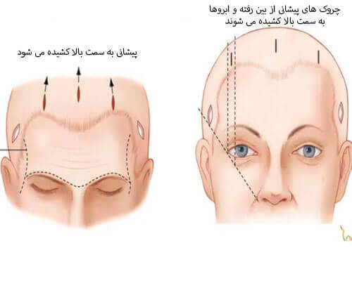 لیفت پیشانی و لیفت ابرو 