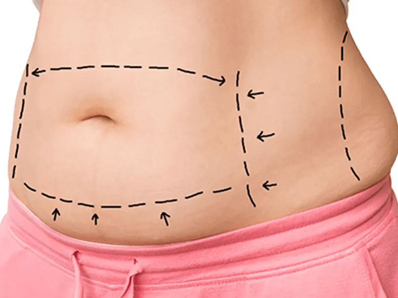 جراحی شکم یا ابدومینوپلاستی