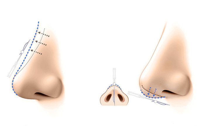 جراحی بینی 5