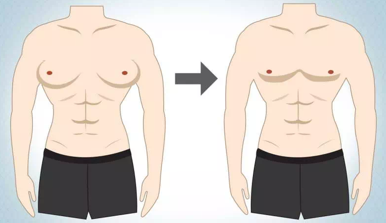 ژنیکوماستی 