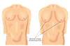 gynecomastia 1
