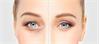 جراحی پلک (بلفاروپلاستی)7