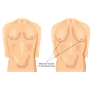 gynecomastia 1