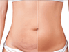 abominoplasty 3
