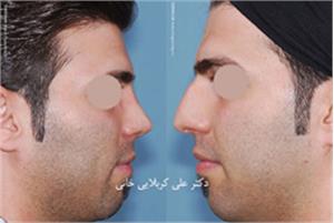 جراحی بینی