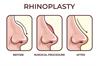 Rhinoplasty